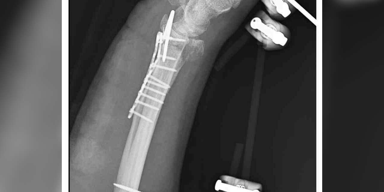 Sahipsiz köpeklerin saldırısından kaçmak isterken bileği kırıldı