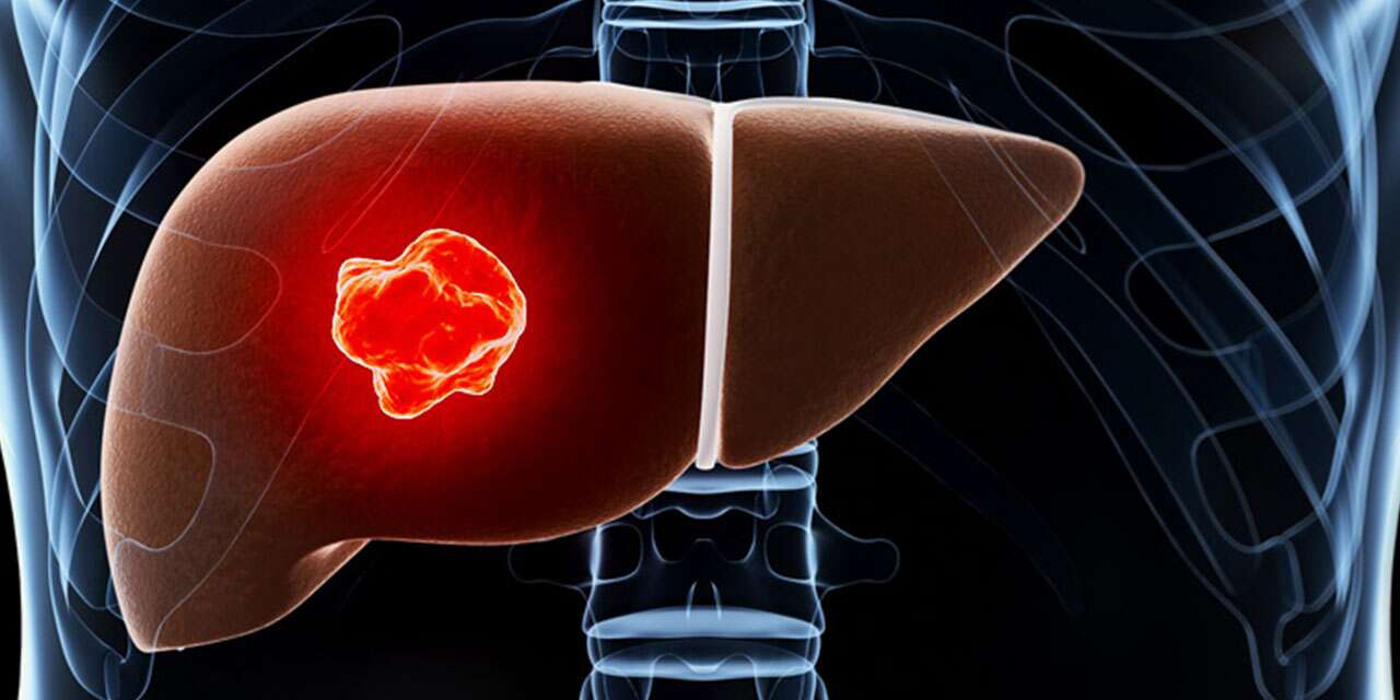 Karaciğerdeki kanserin kaynağı başka organ olabilir